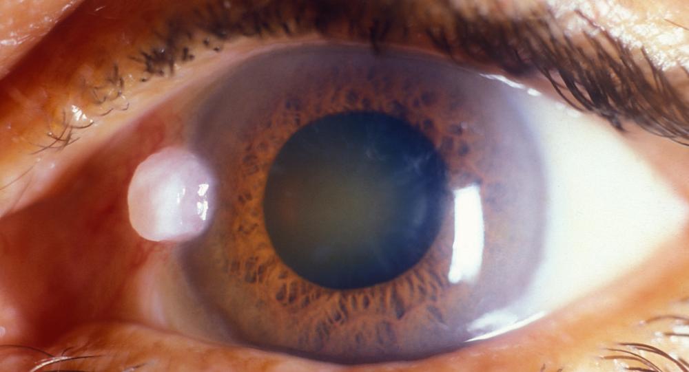 simptome cataracta ochi cum își văd lăcustele vederea